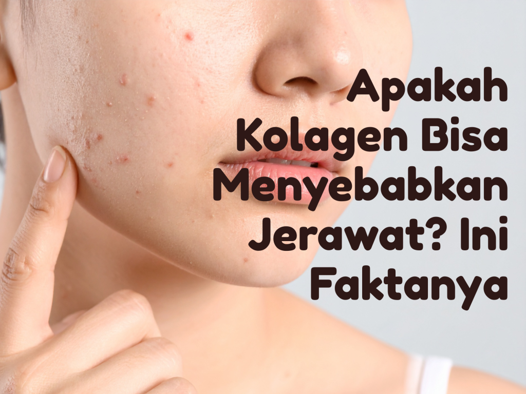 Apakah Kolagen Bisa Menyebabkan Jerawat? Ini Faktanya Apakah Kolagen Bisa Menyebabkan Jerawat? Ini Faktanya