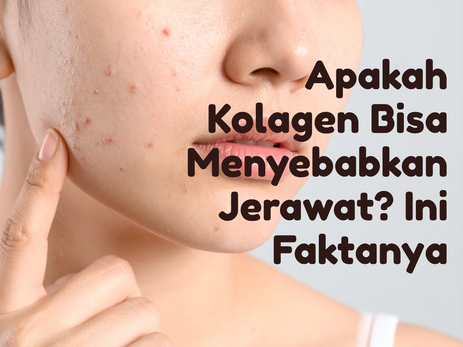 Apakah Kolagen Bisa Menyebabkan Jerawat? Ini Faktanya